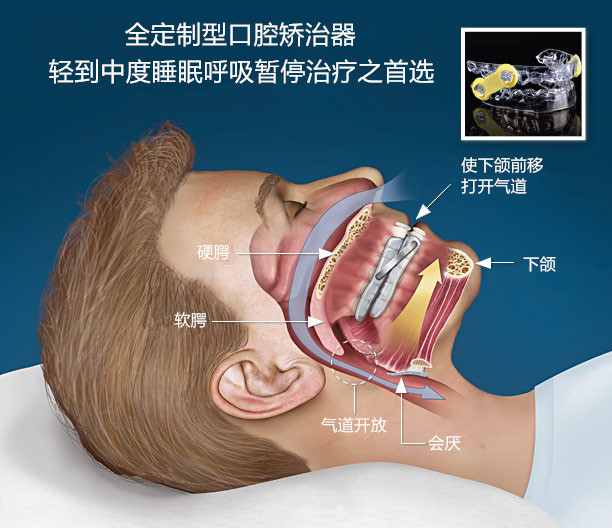 全定制型口腔矫治器.jpg